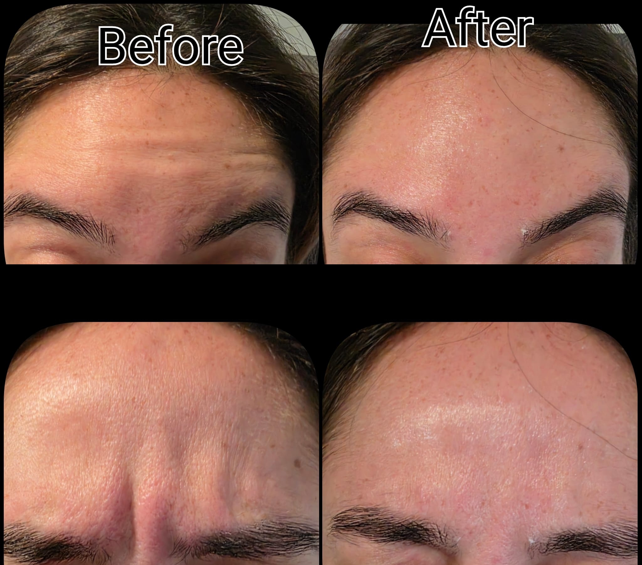 Botox Treatment Before and After 1