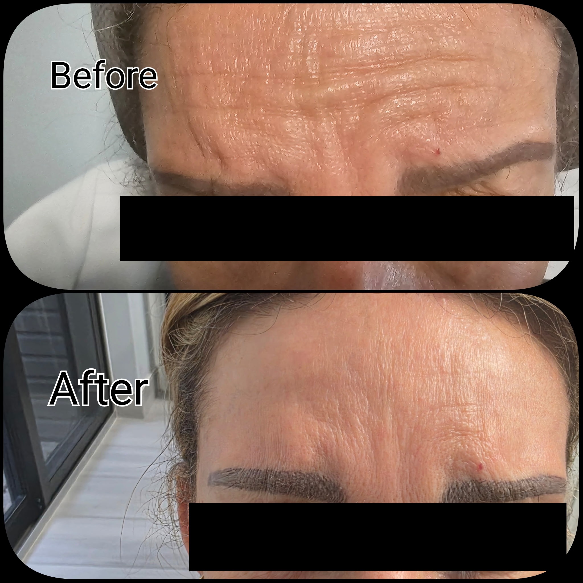 Botox Treatment Before and After 2