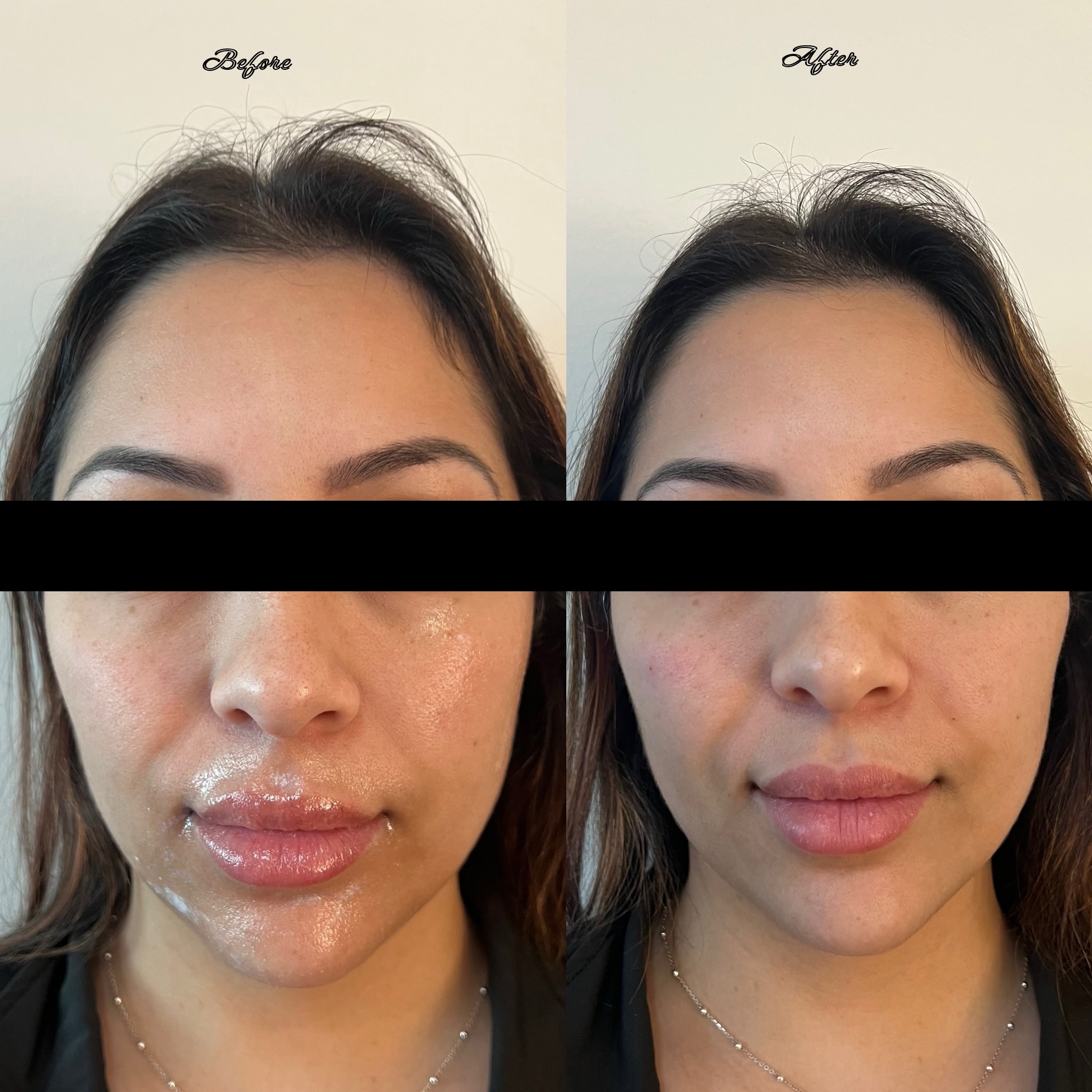 Lip Filler Result 1