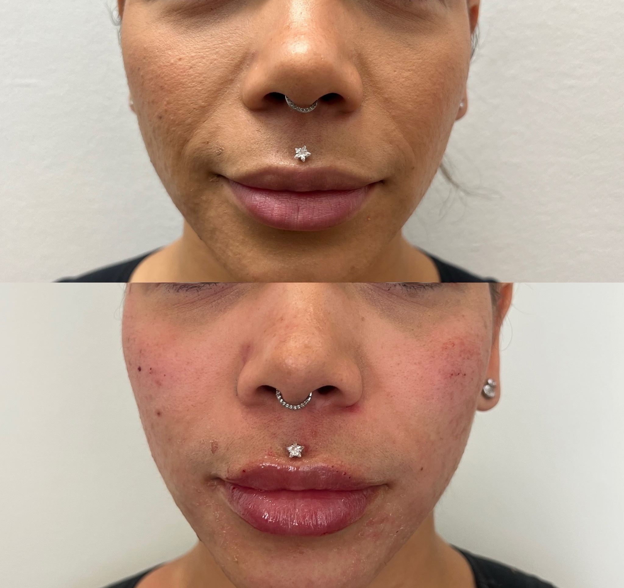 Lip Filler Result 2