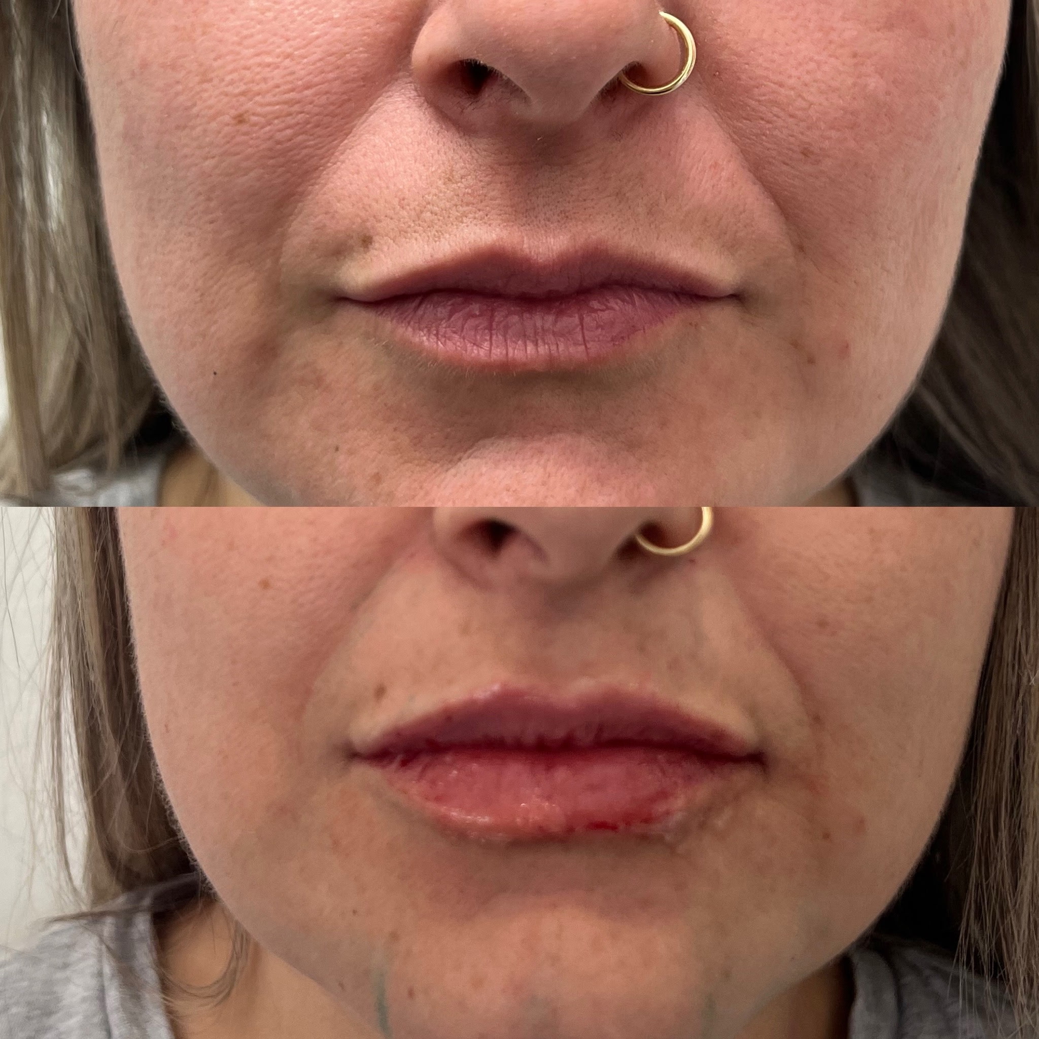 Lip Filler Result 3