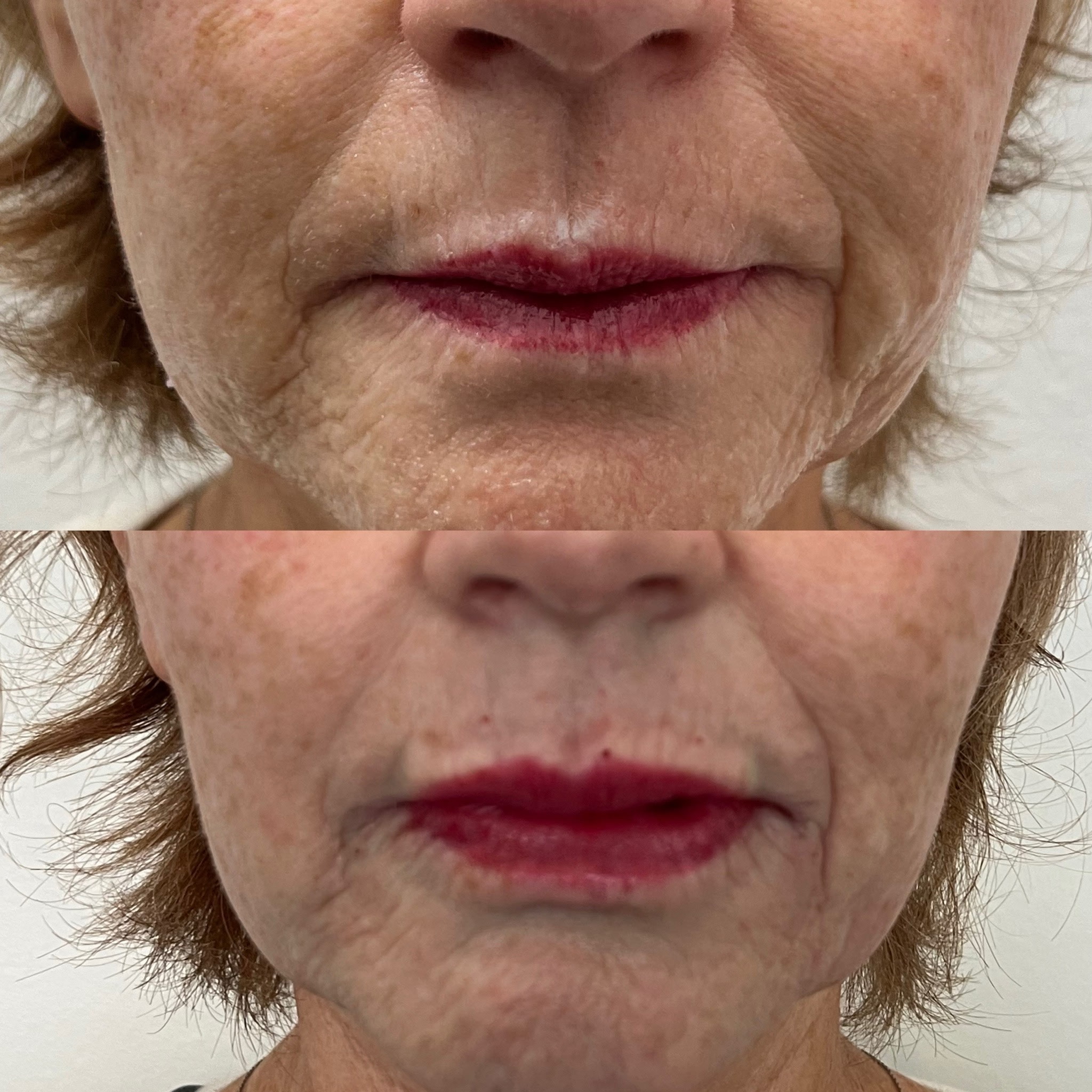 Lip Filler Result 4