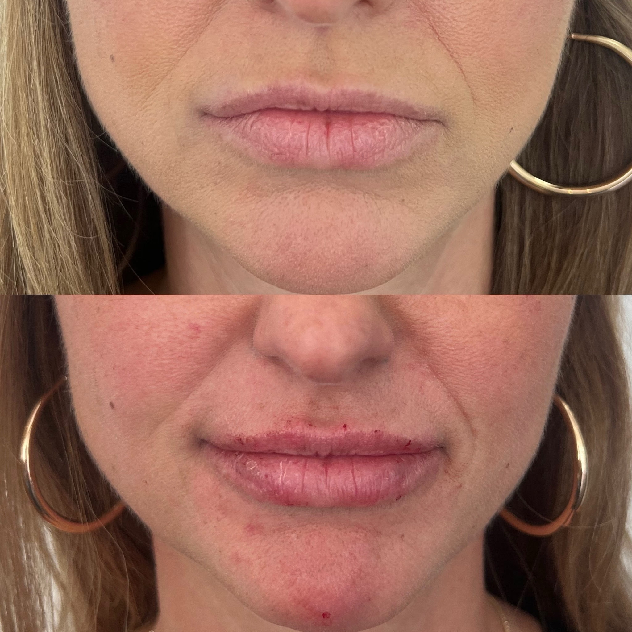 Lip Filler Result 5