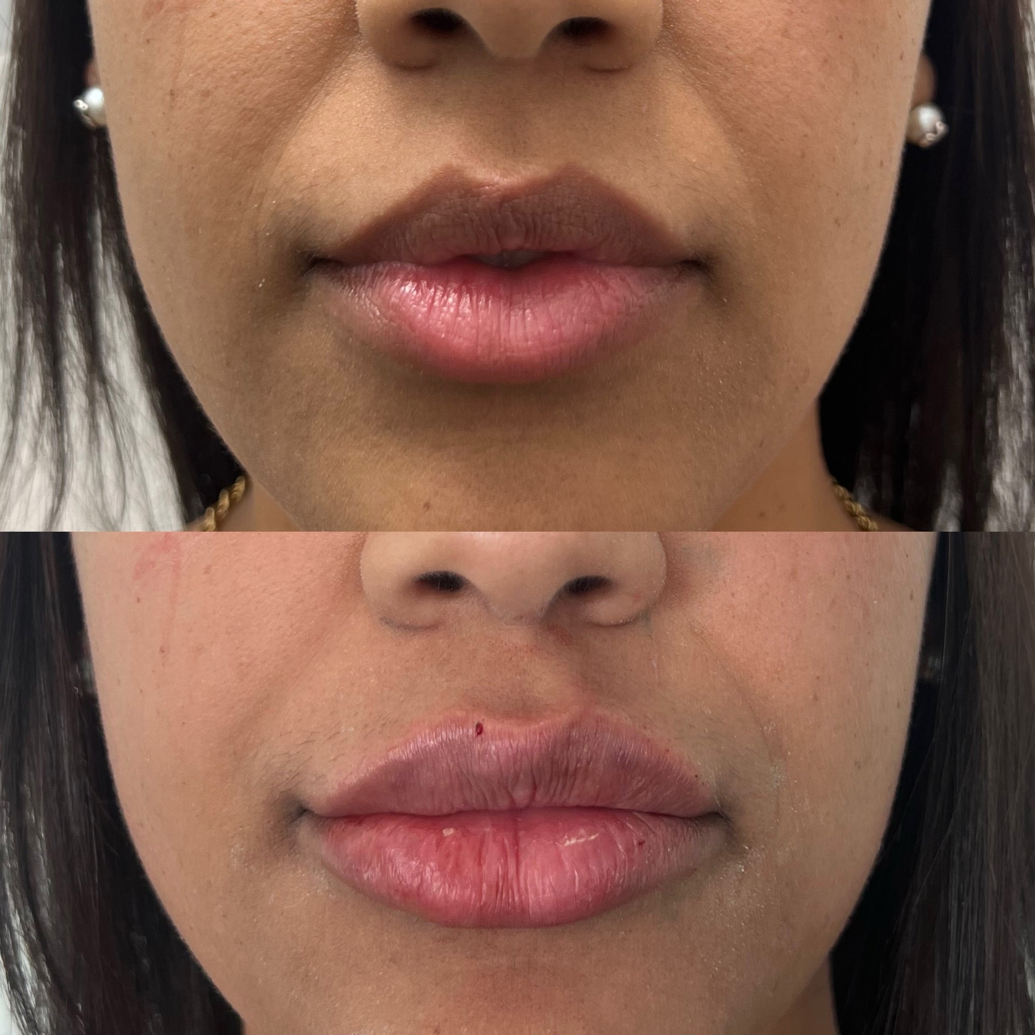 Lip Filler Result 6