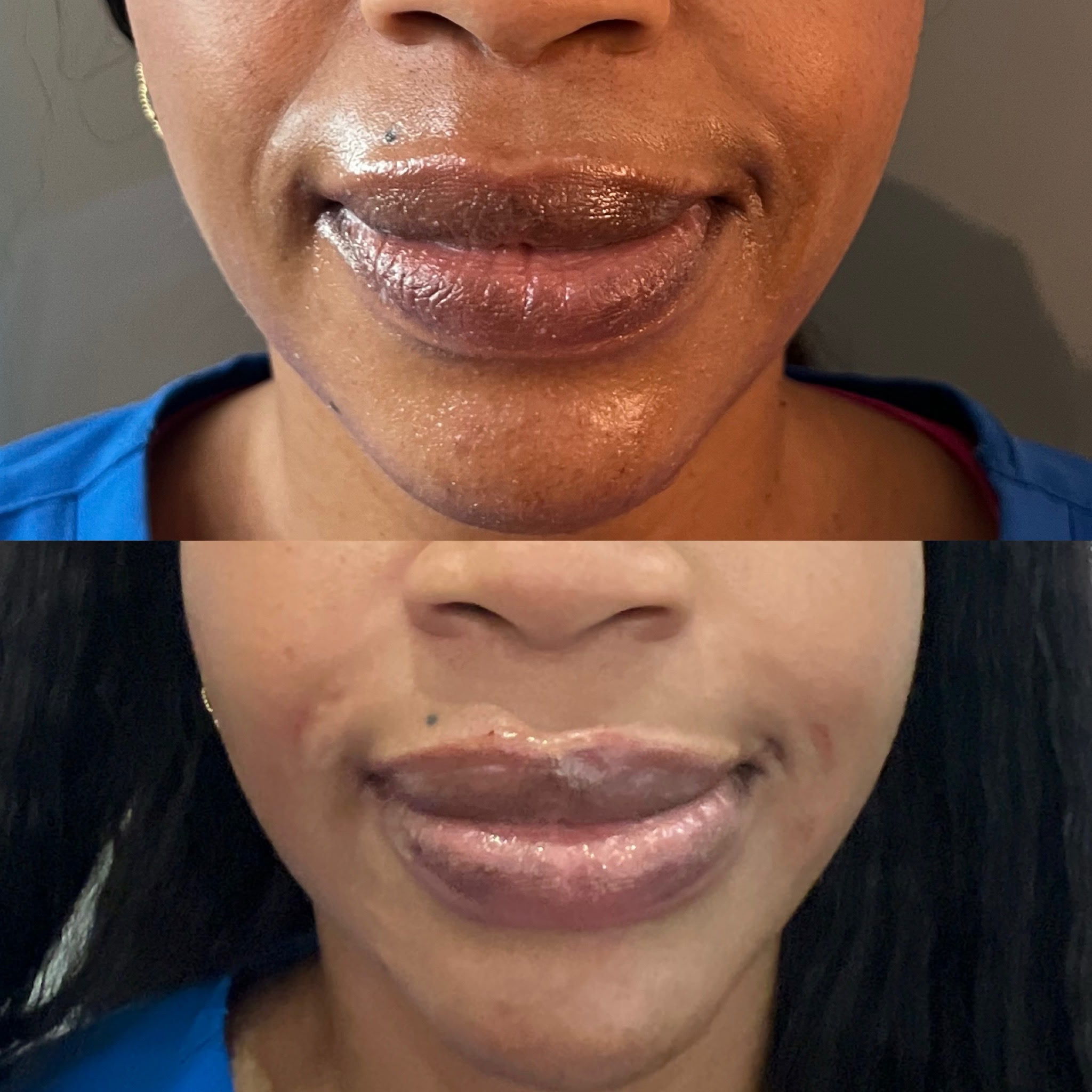 Lip Filler Result 7