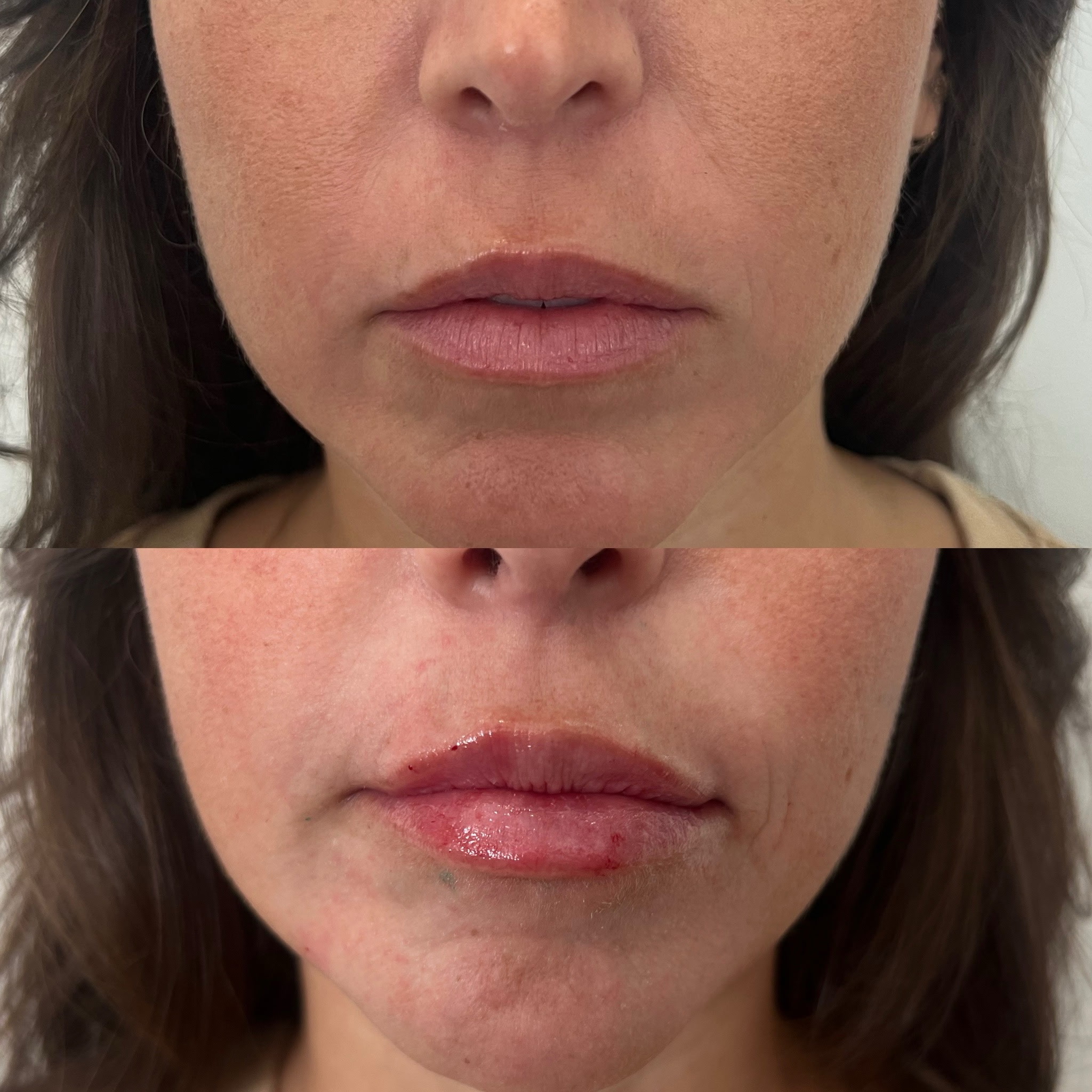 Lip Filler Result 8