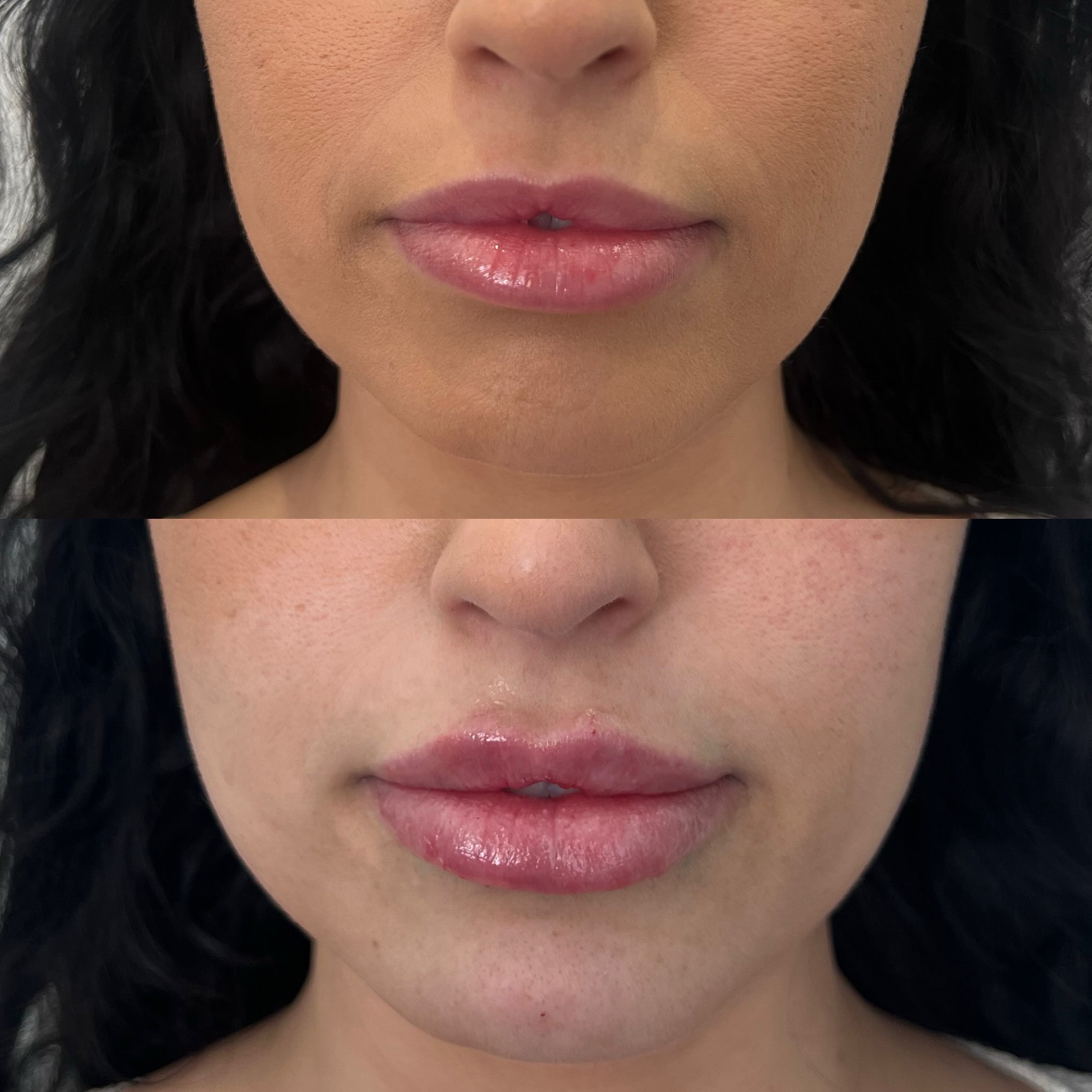Lip Filler Result 9